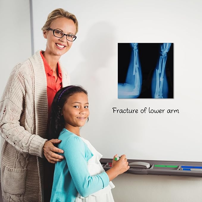 16 Pcs Realistic Broken Bones X-Ray Set - Blue & Black Skeleton X-Rays for Kids (9.8"x9.8") - Pretend Play Doctor Kit Learning Toy, Halloween & Medical School Supplies